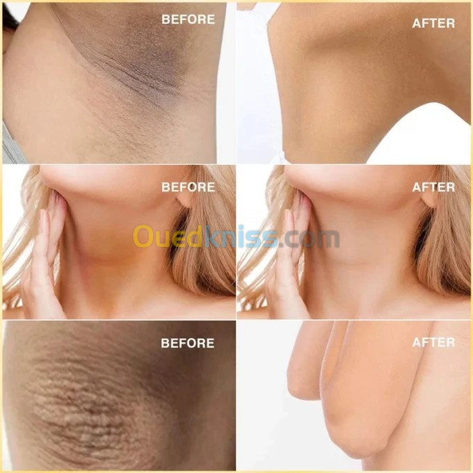 لعلاج التصبغات وآفات حب الشباب Expigment 4 كريم