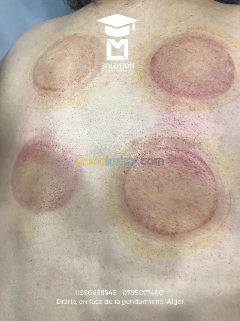 Formation en CUPPING THERAPIE ou Hidjama médicale