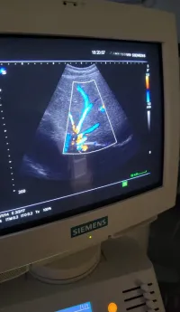 Echographe Siemens G60S ( Cardio) 