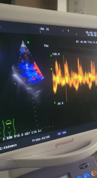 Echographe Aloka Alpha7 ( Cardio )