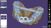 EXOCAD 3.1 EXOPLAN PARTIALCAD