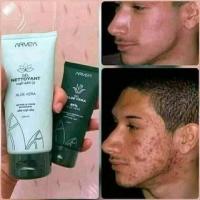 cosmetiques-beaute-لازالة-حب-الشباب-واثاره-tipaza-algerie