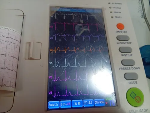 Ecg