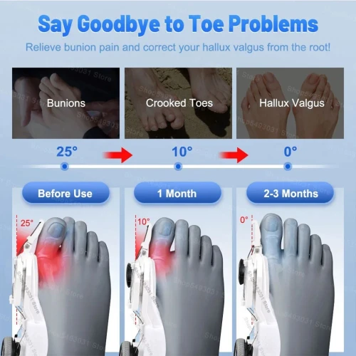 Correcteur Hallux Valgus avec Molette Réglable pour Femme et Homme