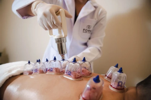 Cupping Thérapie (Hijama,حجامة) et médecine chinoise