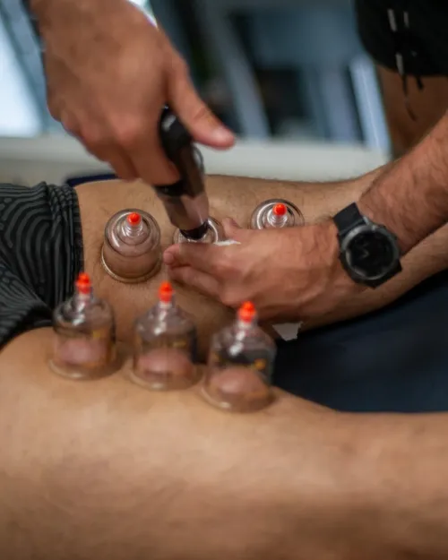 Cupping Thérapie (Hijama,حجامة) et médecine chinoise