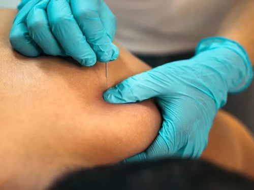 Cupping Thérapie (Hijama,حجامة) et médecine chinoise