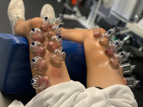 العلاج بالحجامة والطب الصيني