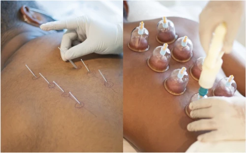 Cupping Thérapie (Hijama,حجامة) et médecine chinoise