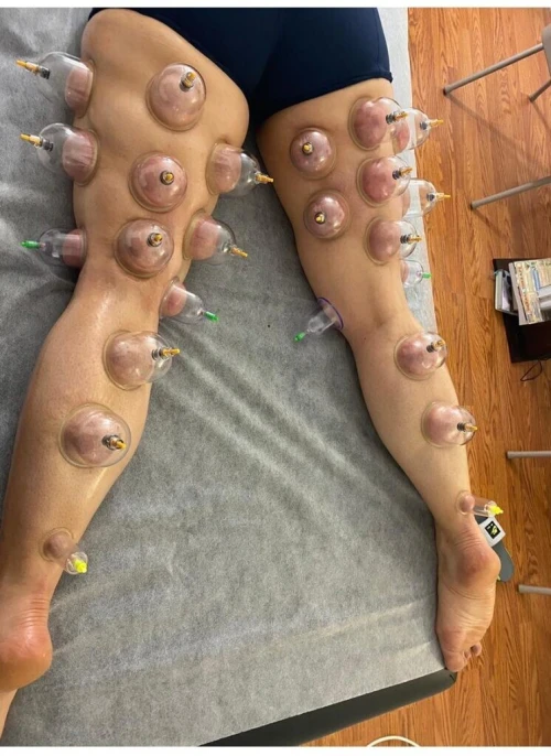 العلاج بالحجامة والطب الصيني