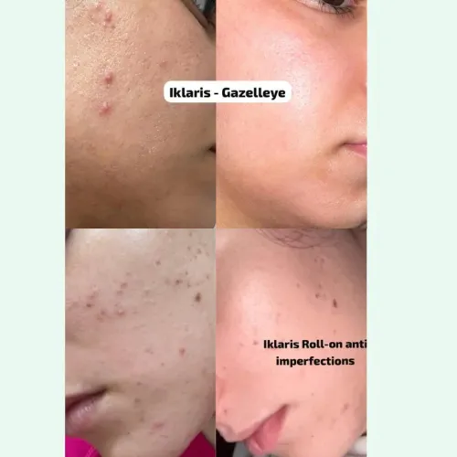 Gazelleye Iklaris / Roll-on naturel anti-imperfections & boutons