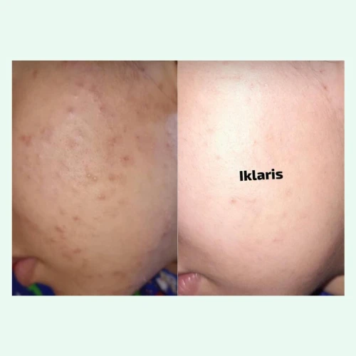 Gazelleye Iklaris / Roll-on naturel anti-imperfections & boutons