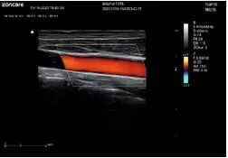 Echographe portable Doppler neuf
