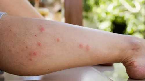 Extermination des puces de chat et puces de chien البرغوث à ain témouchent 
