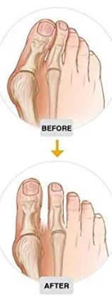 Attelle HALLUX VALGUS 