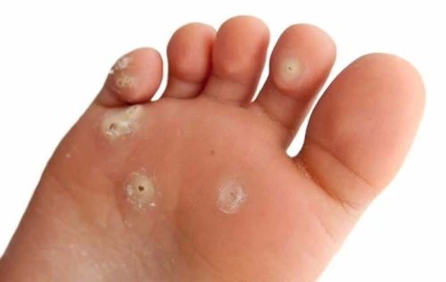 Traitement Chirurgical Ambulatorie  Lipome, Kyste, Ongle, Pied Diabétique