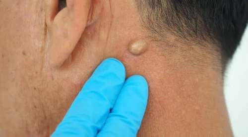 Traitement Chirurgical Ambulatorie  Lipome, Kyste, Ongle, Pied Diabétique
