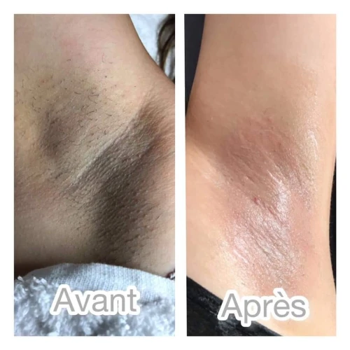 Épilation laser définitive/ Détatouage