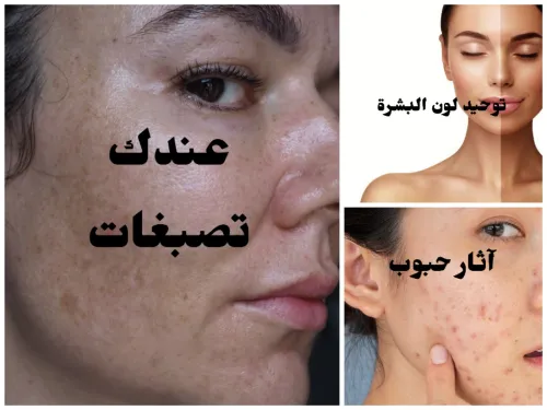 الحل الامثل لتصبغات و أثار الحبوب وحروق الشمس في الوجه باقة فيتامين c