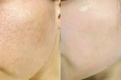 ماسك لتبييض