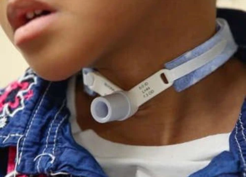 Tube de tracheotomie
