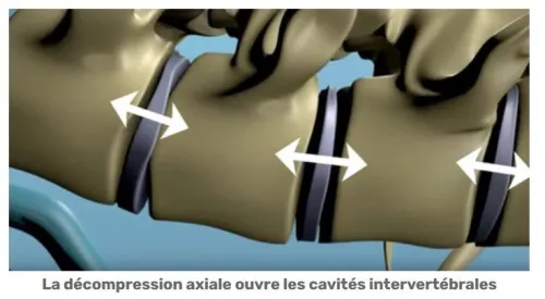  Nubax appareil de soin personnel de la colonne vertébrale, Hernie discale, sciatique... 