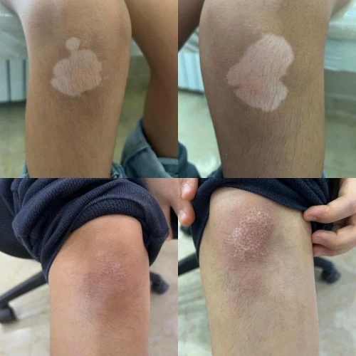 Excimer laser 308nm vitiligo