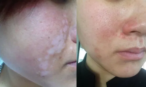 Excimer laser 308nm vitiligo