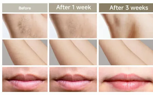 IPL LASER original certifié, 3 mode , refroidissement,999999 flash avec résultats 2 mois